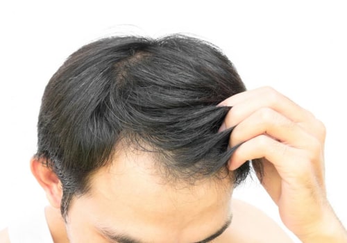 Preventing Hair Loss Naturally